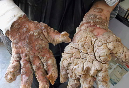 chto zhe cheloveka virus simptomi papillom kakogo vremeni Вирус папиллом человека симптомы фото
