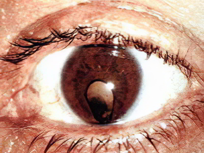 катаракта мушки