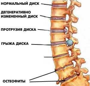 переохлаждение остеохондроз