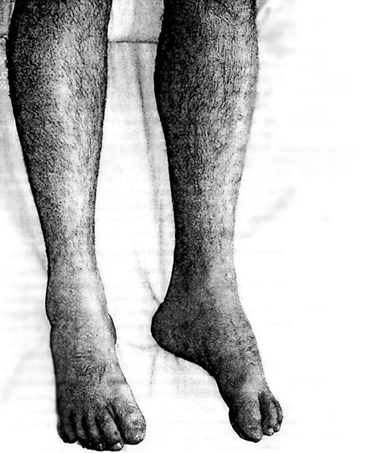 Лечение атрофии мышц на ногах голени thumbnail