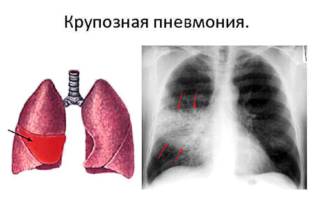 Что такое пневмония и чем она опасна фото thumbnail
