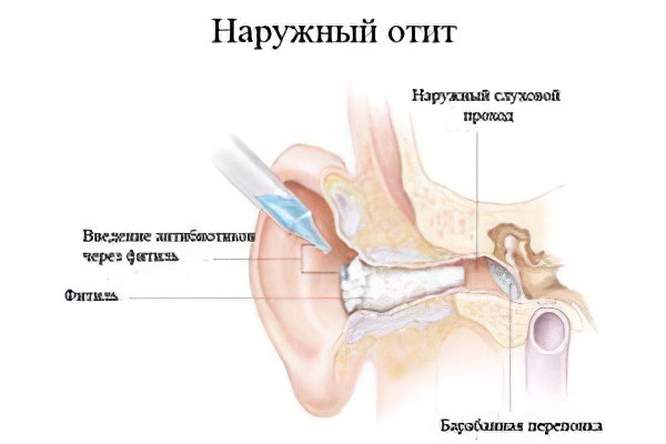 Как лечить отит наружного уха у взрослых thumbnail
