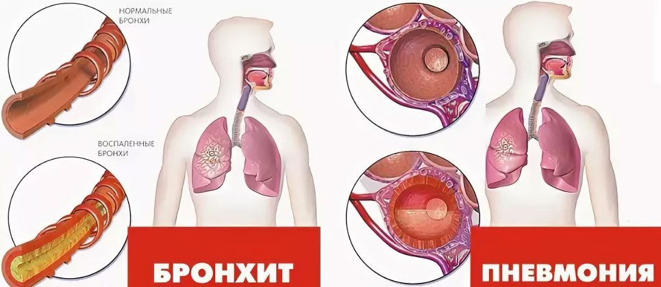 Пневмония у женщин симптомы и лечение thumbnail