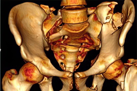Методы лечения перелома костей таза thumbnail