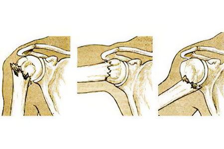 Закрытый перелом хирургической шейки правой плечевой кости thumbnail