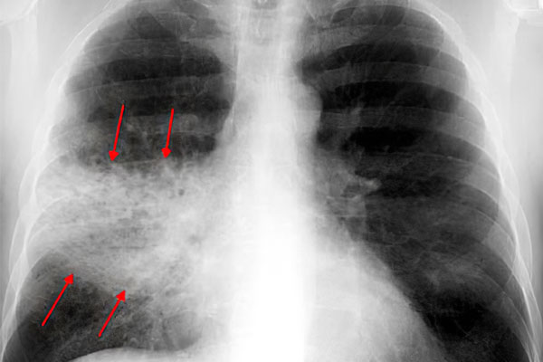 Пневмония признаки заболевания и их лечение thumbnail