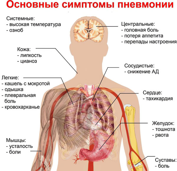 Какие симптомы у болезни пневмония thumbnail