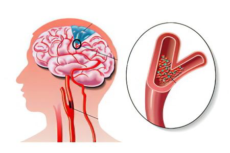 Гипоксия головного мозга после инфаркта thumbnail