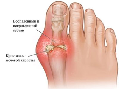 Болезни ног варикоз артрит подагра лечение и профилактика