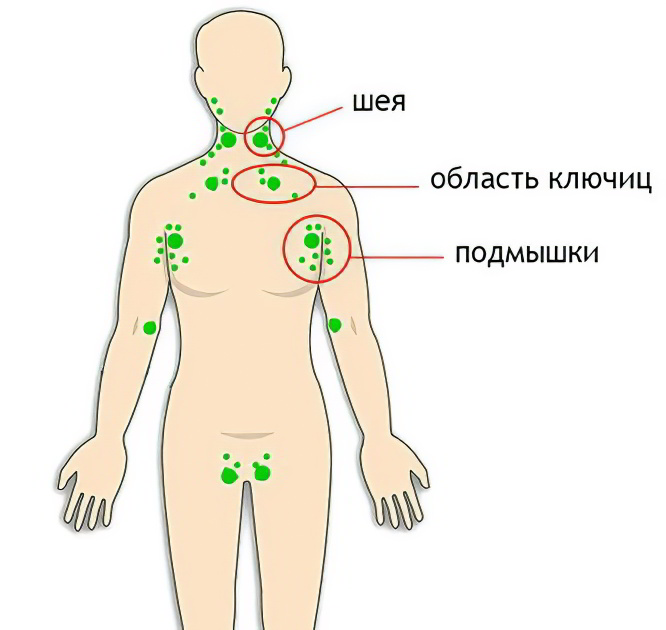 Симптомы лимфаденита