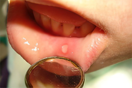 От чего появляется стоматит во рту лечение thumbnail