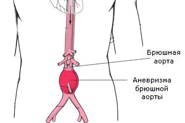 Брюшной отдел аорты диаметр