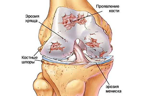 Артралгия коленного сустава