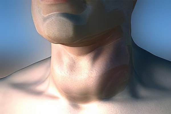 Зоб при щитовидной железе фото
