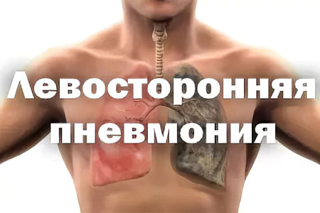Что такое левосторонняя пневмония и как ее лечить thumbnail