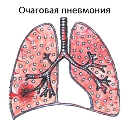 Очаговая пневмония