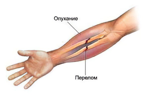 Перелом кости руки