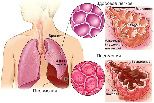 Признаки пневмонии у взрослого без температуры и кашля симптомы thumbnail