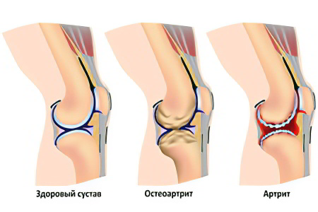 Причины хруста в коленных суставах