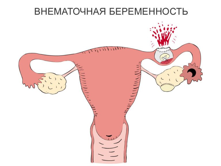 Как понять что у тебя внематочная беременность симптомы на ранних сроках. Смотреть фото Как понять что у тебя внематочная беременность симптомы на ранних сроках. Смотреть картинку Как понять что у тебя внематочная беременность симптомы на ранних сроках. Картинка про Как понять что у тебя внематочная беременность симптомы на ранних сроках. Фото Как понять что у тебя внематочная беременность симптомы на ранних сроках