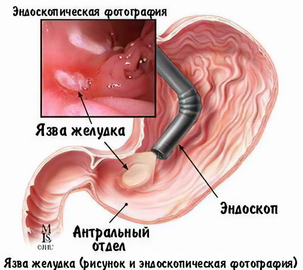 Язвенная болезнь желудка картинки