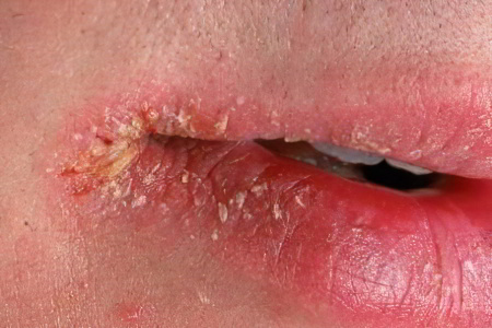 Трещины в уголках рта – лечение лазером