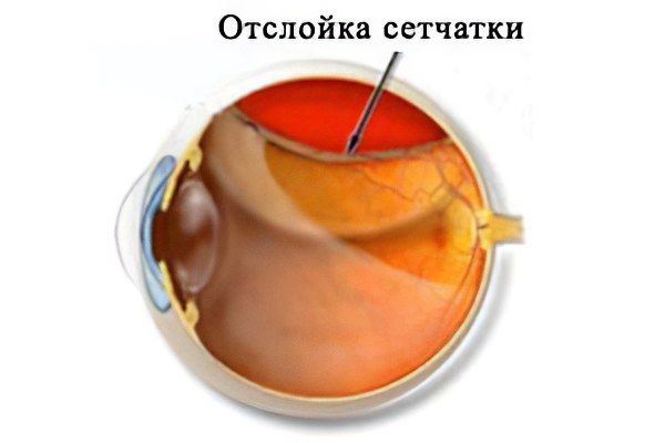 Отслоение сетчатки глаза симптомы фото