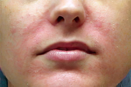 Причины раздражения кожи на лице