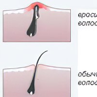Как остановить выпадение волос: 5 главных шагов