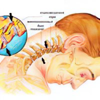 Как вылечить зажатый нерв в спине